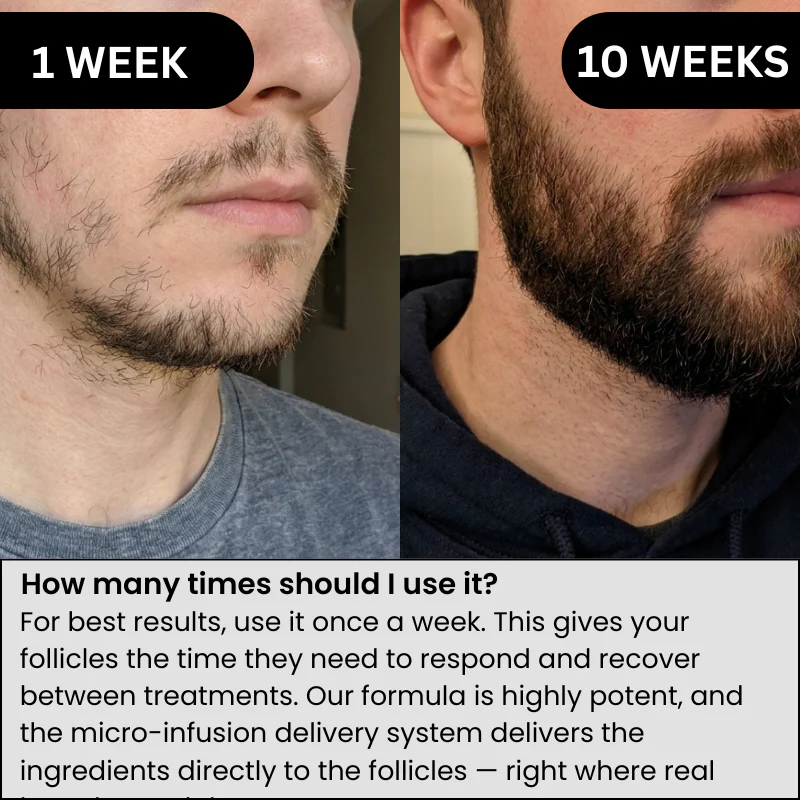 AlphaInfuse™ Beard Growth System - Image 3