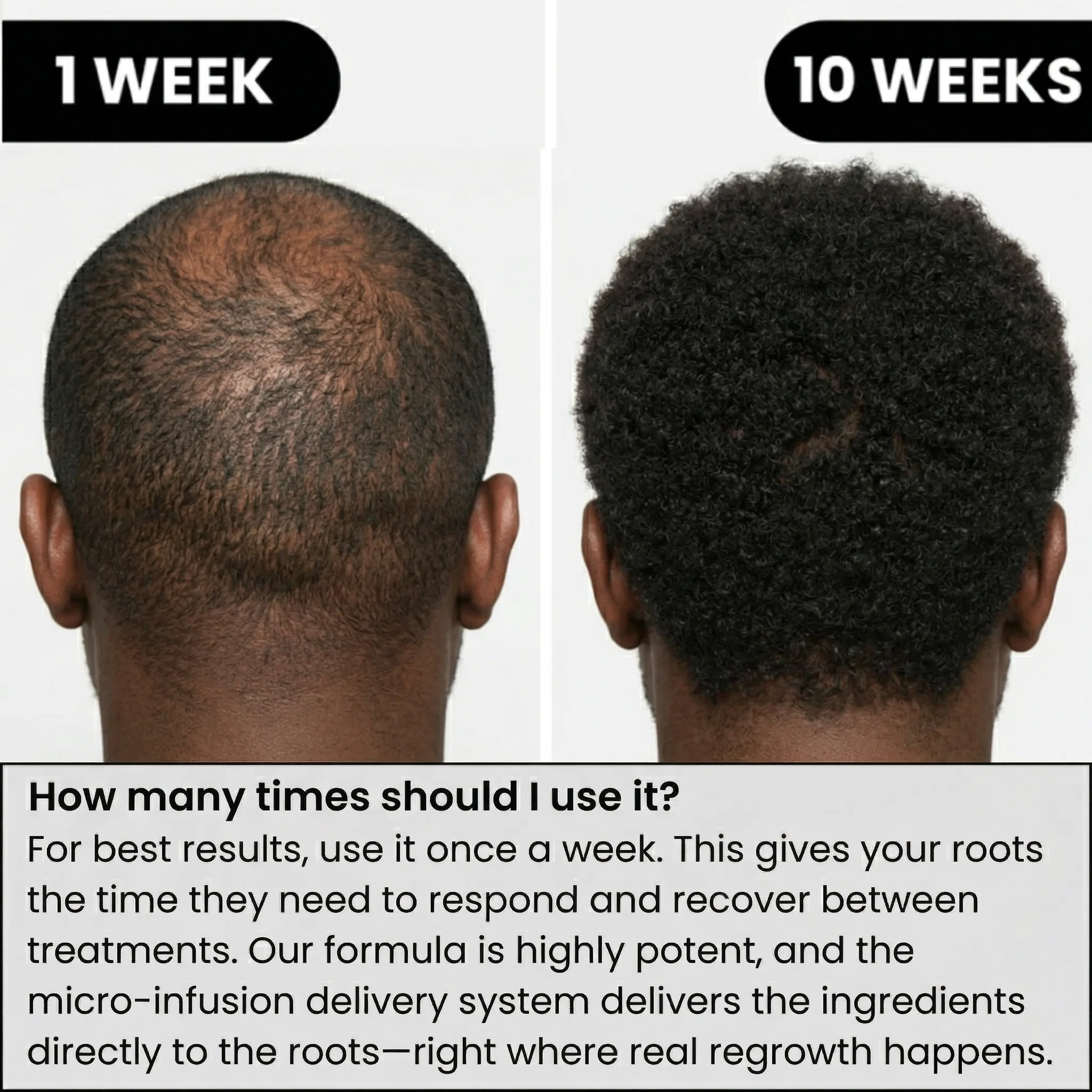 AlphaInfuse™ Hair Regrowth System - Image 3